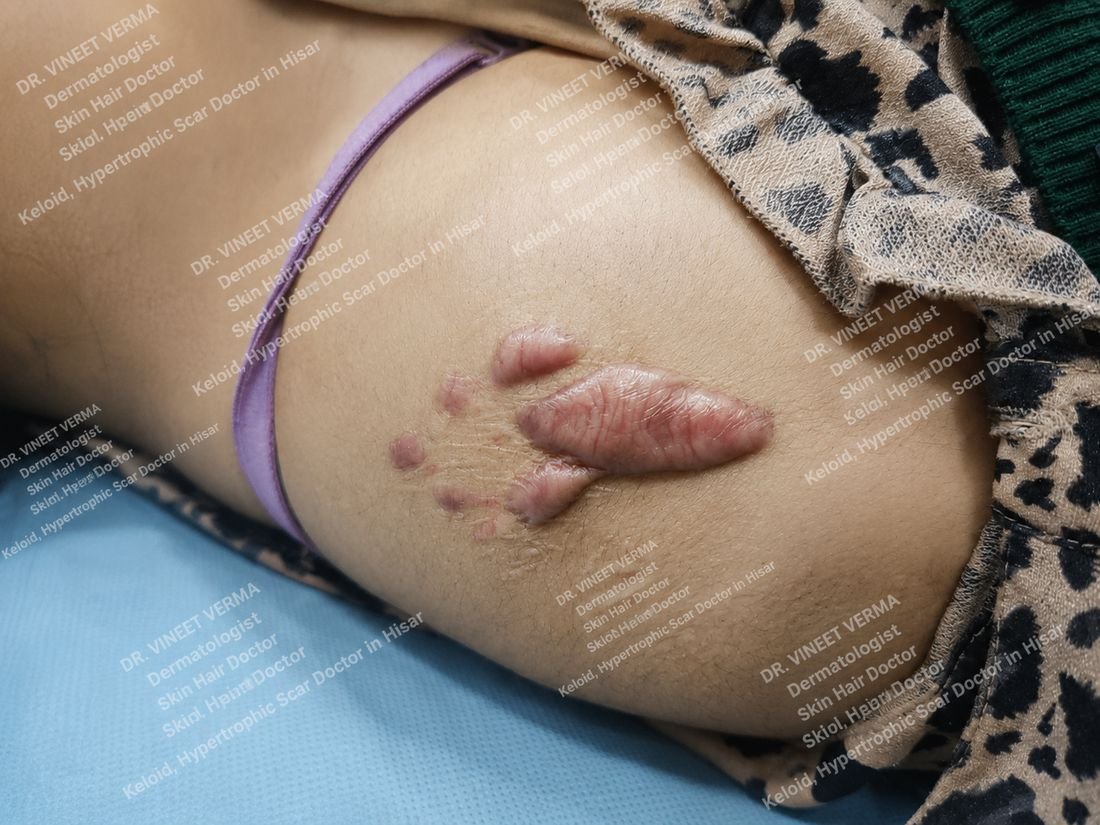 Keloid and hypertrophic scar on arm treated at Dr. Vineet Verma skin clinic Hisar Haryana