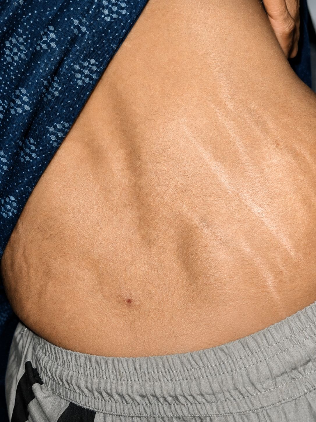 Stretch marks on abdomen treated with laser and microneedling at Dr. Vineet Verma skin clinic Hisar